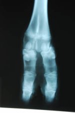 Shortie distal limb deformity XR 2.jpg